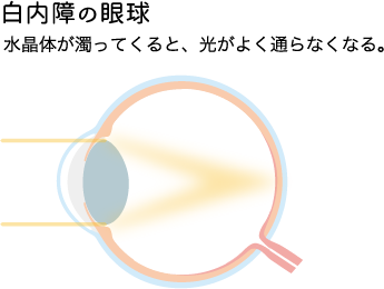 白内障の眼球